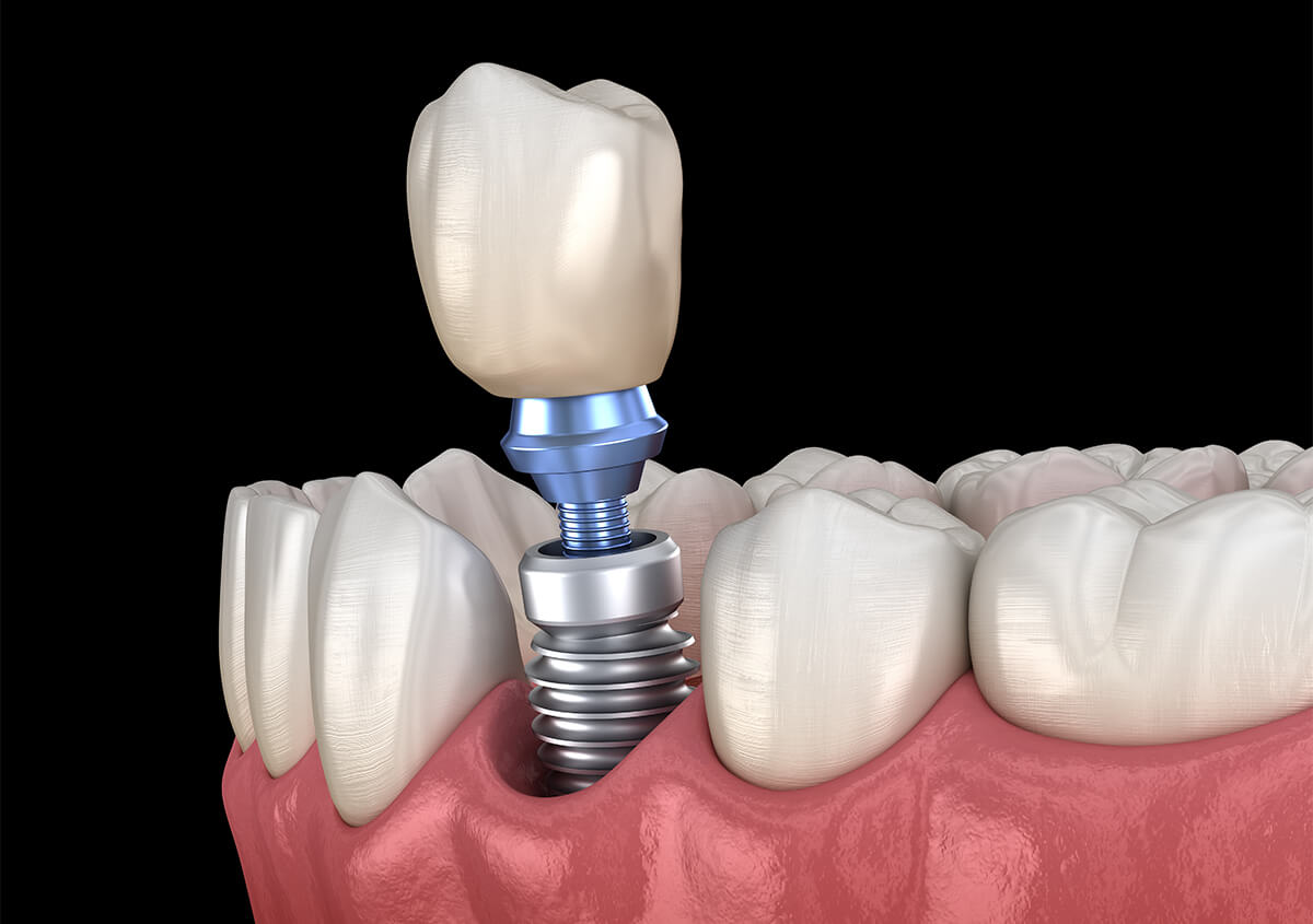 Dentist That Do Implants in San Diego CA Area